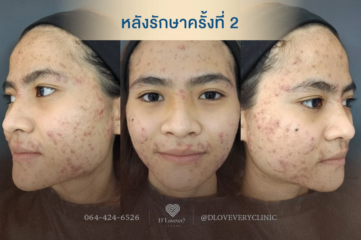 ถ้าหน้าติดสารสเตียรอยด์จะรู้ได้ยังไง อาการแบบไหนต้องระวัง?