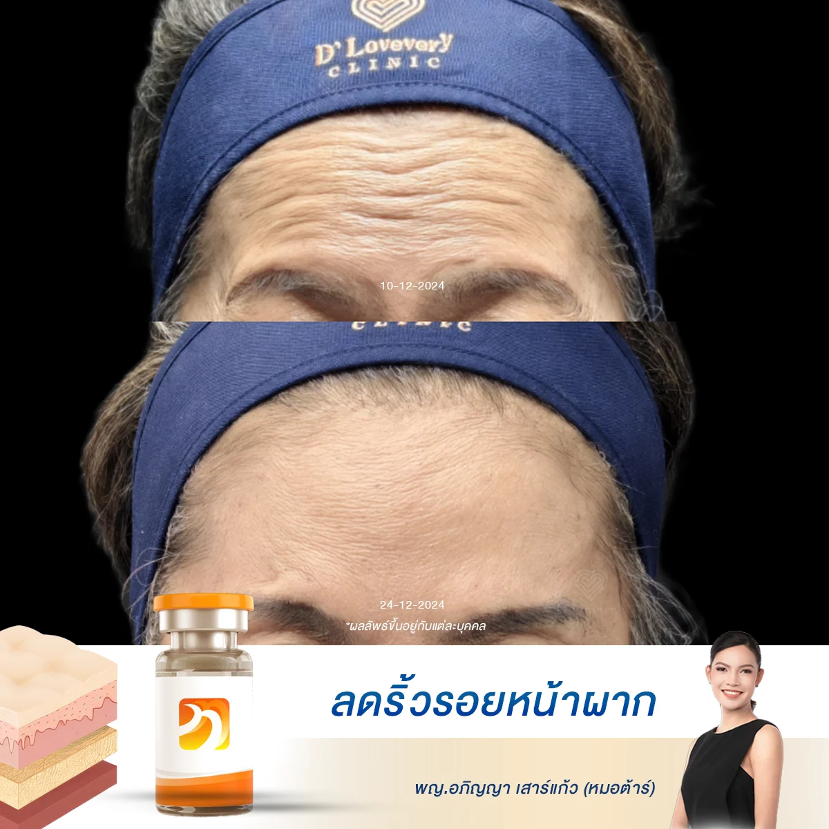 [รีวิวโบท็อกซ์ในวัย 60] เผยเคล็ดลับลดริ้วรอยที่หลายคนไม่กล้าทำ แค่ 3 วัน ริ้วรอยจาง