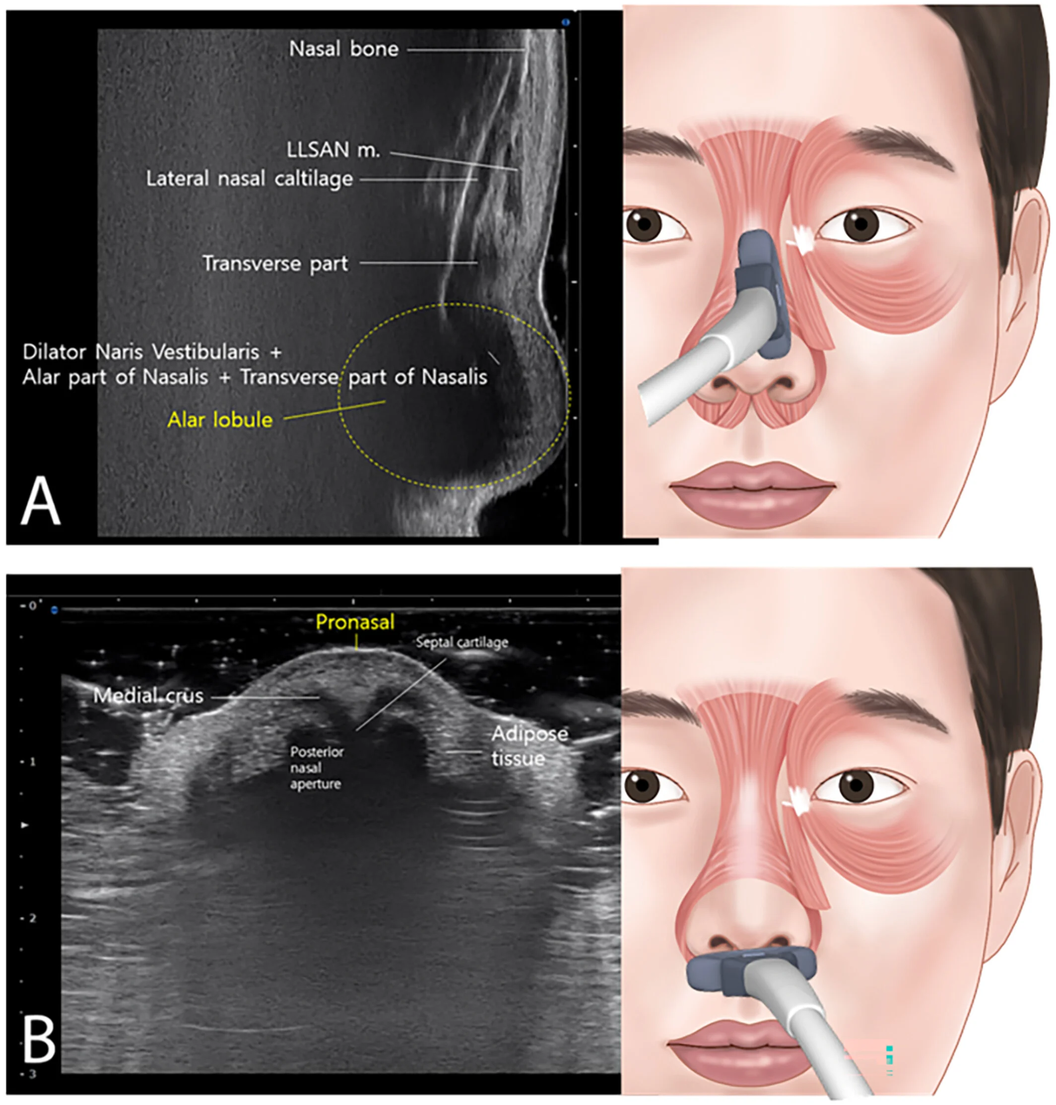 Nasal tip ultrasound anatomy for rhinoplasty: alar lobule and septal cartilage