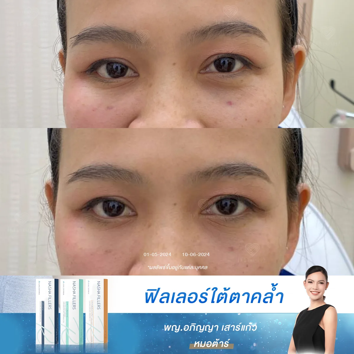[รีวิวฉีดฟิลเลอร์] ริ้วรอยใต้ตาเล็กๆ ทำให้ดูโทรมได้ แต่แค่ 20 นาที ปัญหานี้ก็หมดไป!
