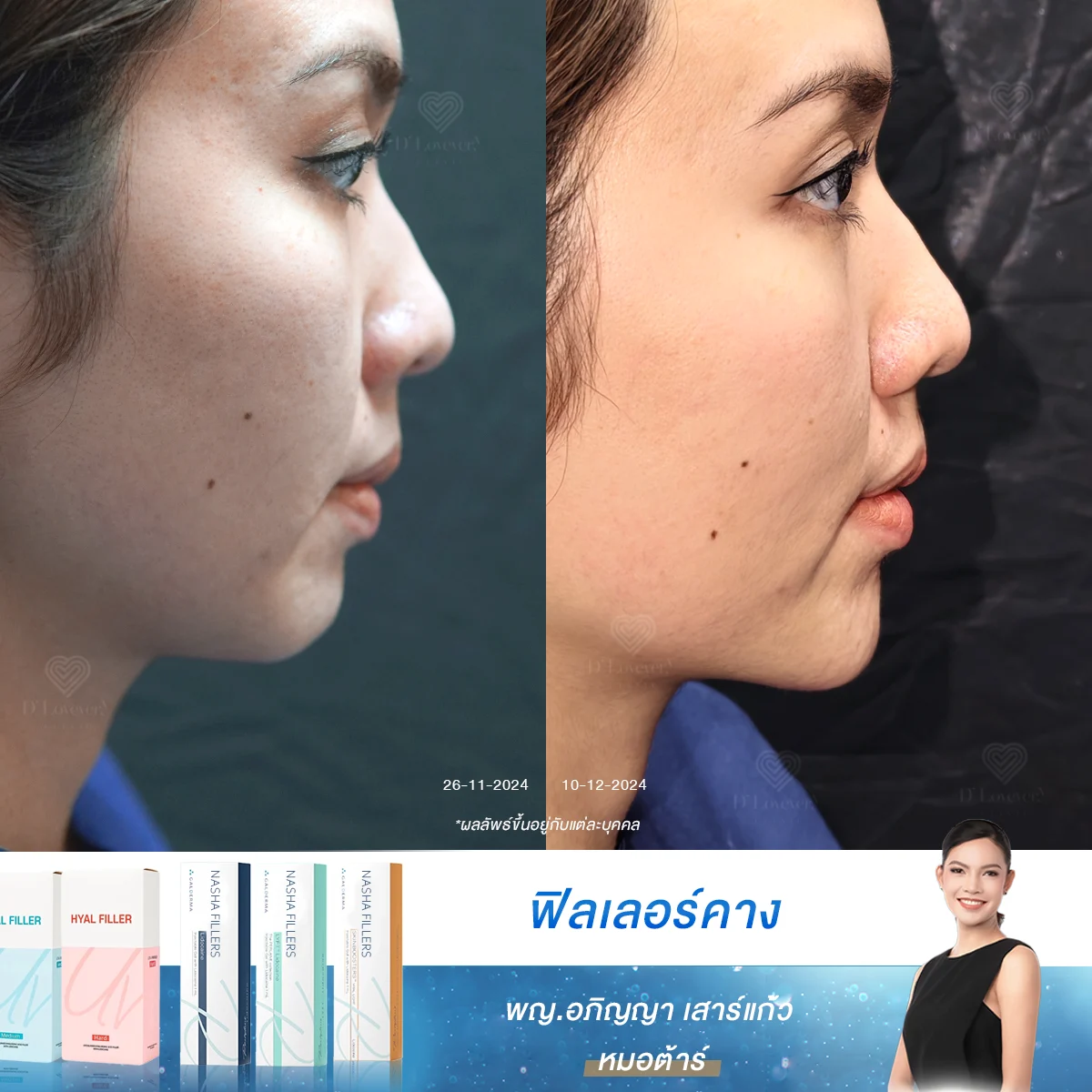 Case100 Chin Filler Miss Noon Before After 2