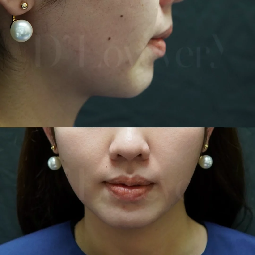 เผยภาพก่อน-หลังเติมฟิลเลอร์คาง คางเปลี่ยน หน้าสวยขึ้นจริงหรือ?