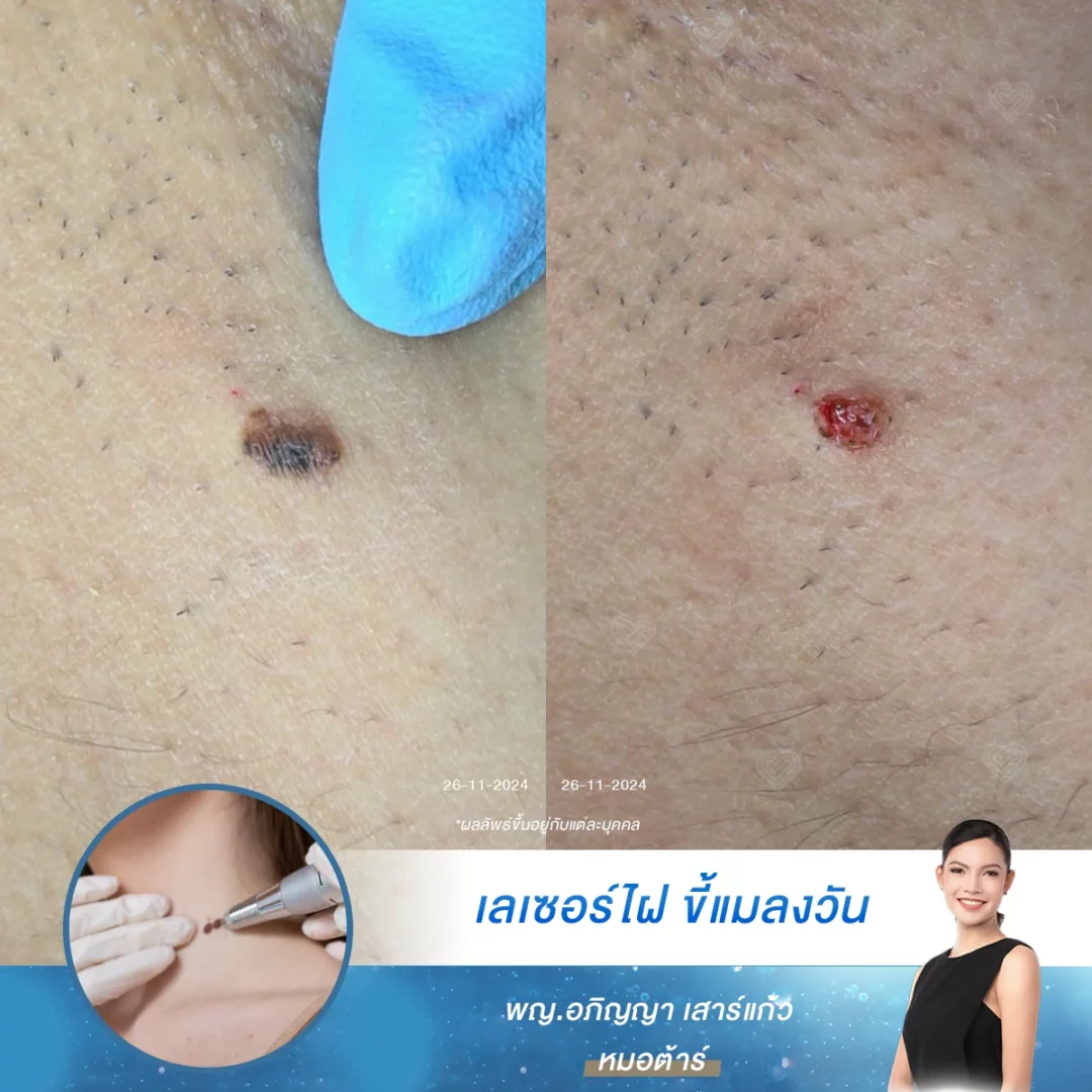 ผลลัพธ์หลังจี้ไฝ