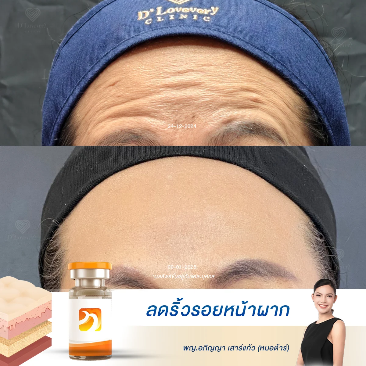 [รีวิว Botox] ไม่ต้องกลัวหน้าแข็ง! หมอต้าร์เผยวิธีฉีดให้สวยธรรมชาติ