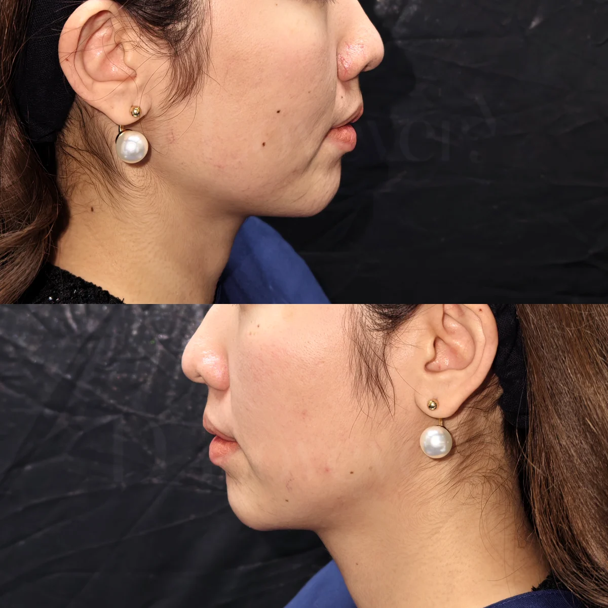 [รีวิวเลเซอร์] รอยสิวที่คาง กรอบหน้า ไม่ใช่เรื่องใหญ่ของ D’Lovevery Clinic