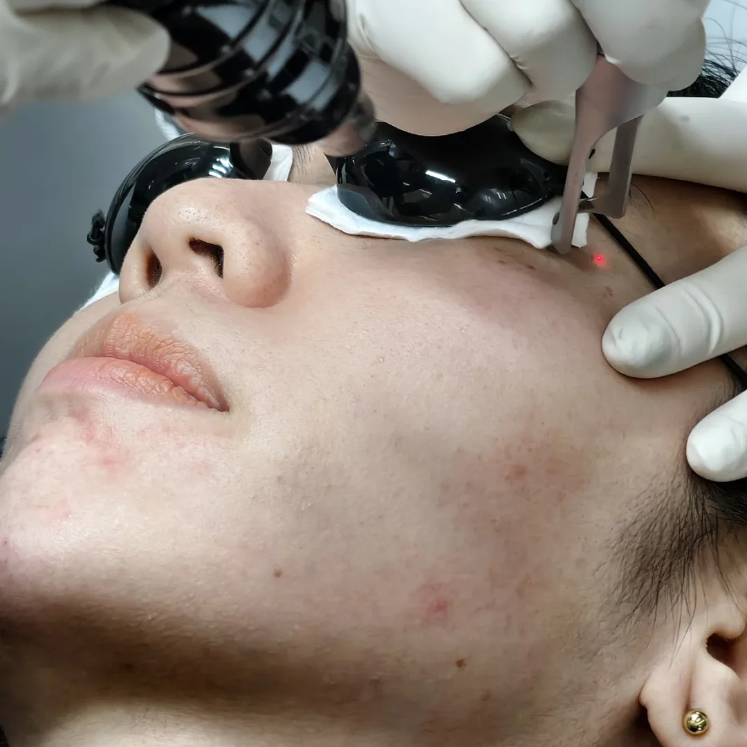 จากรอยสิวลึก เป็นผิวใสใน 1 เดือนที่ D’Lovevery Clinic