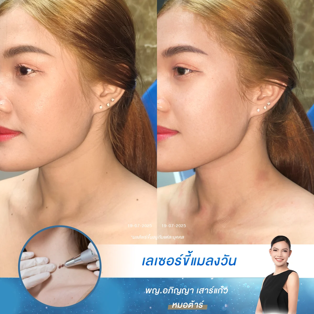 [Co2 Laser รีวิว] ใครอยากมีผิวใสไร้จุด อยากกำจัดขี้แมลงวัน กระเนื้อ มาทำเลเซอร์ที่ D’Lovevery Clinic เห็นผลในครั้งเดียว