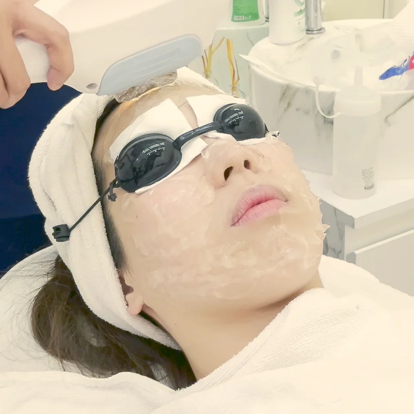 ipl laser หน้าใส ทำได้อาทิตย์ละครั้ง