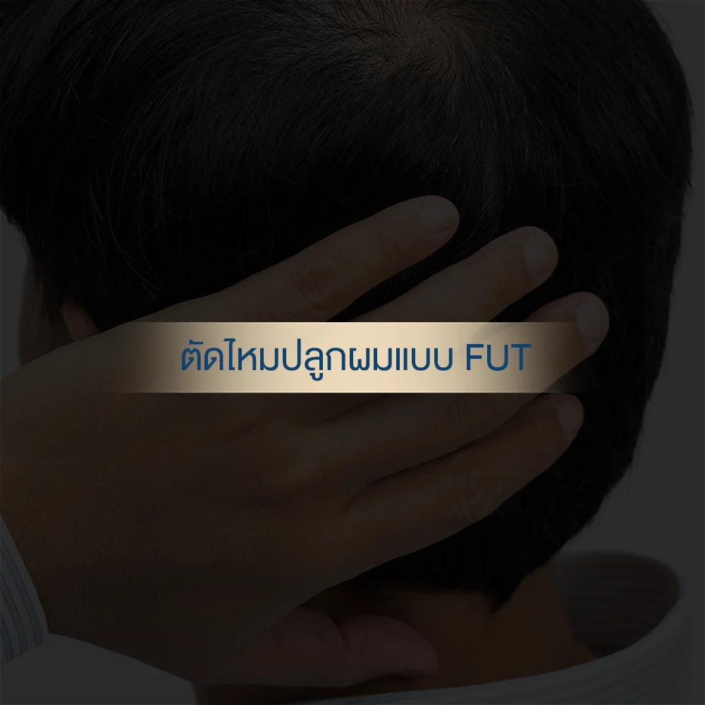 Hair transplant FUT suture removal on scalp with supportive hand
