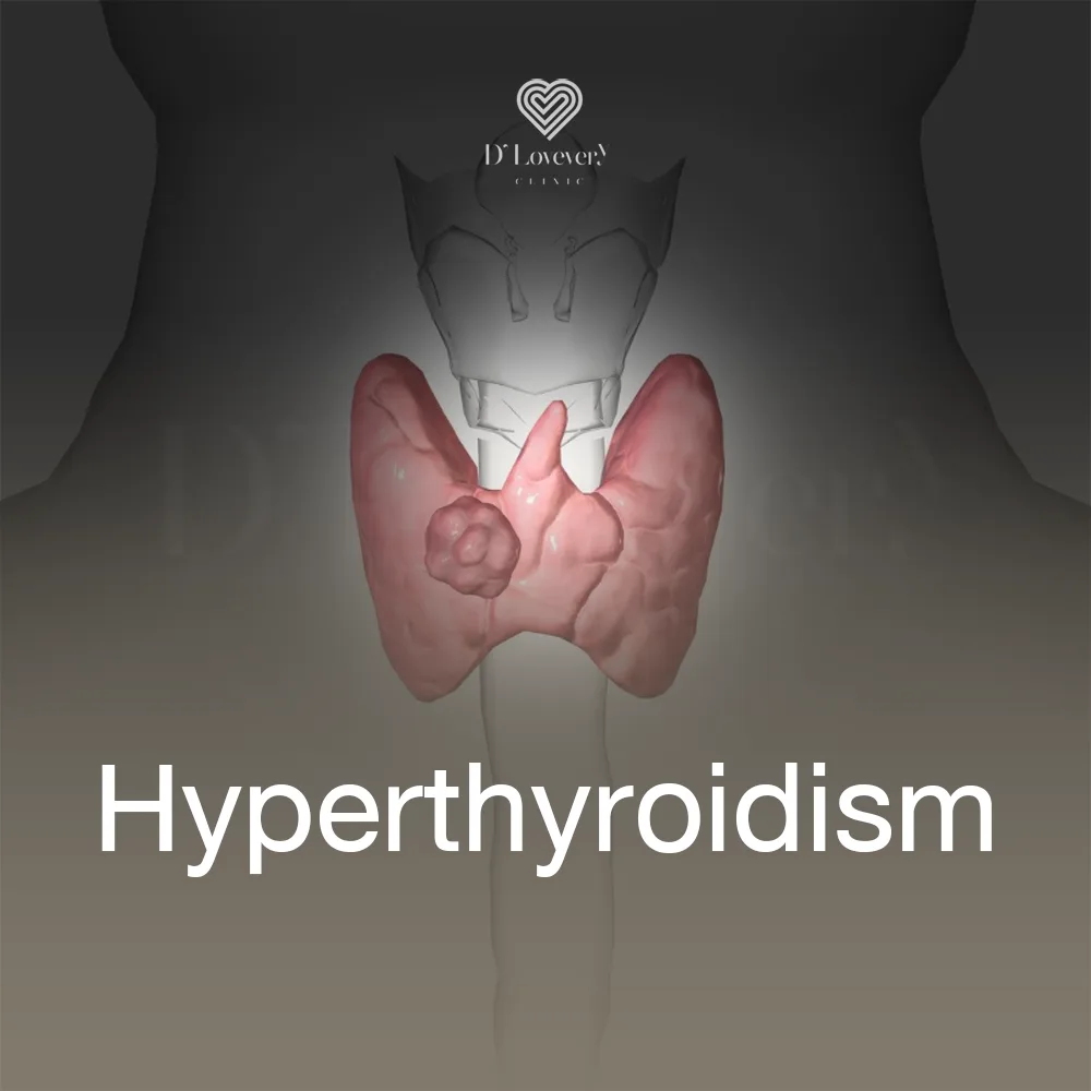 Hyperthyroidism medical illustration: translucent thyroid with left-sided nodule