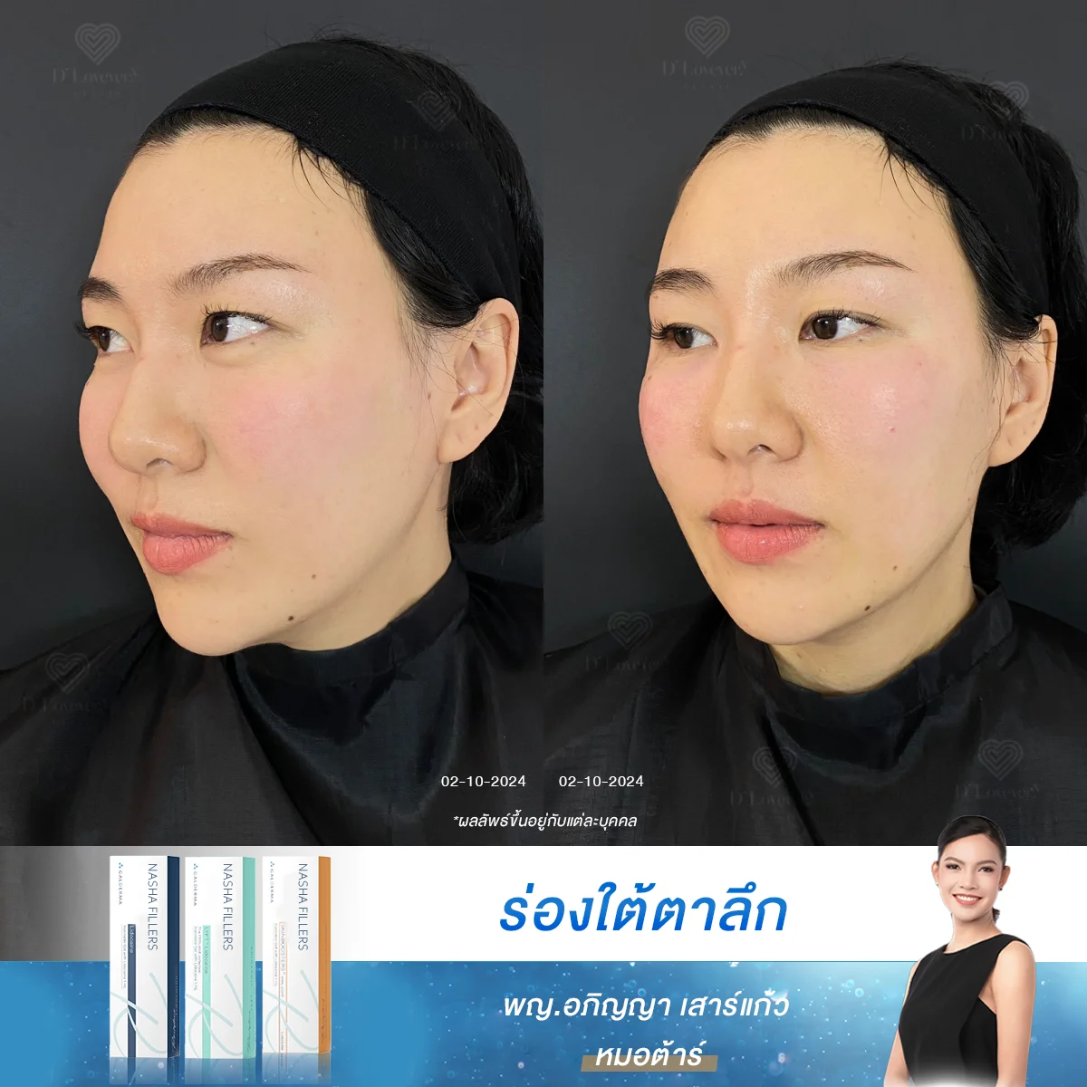 Miss Nan Under Eye Filler Case86 Before After 3
