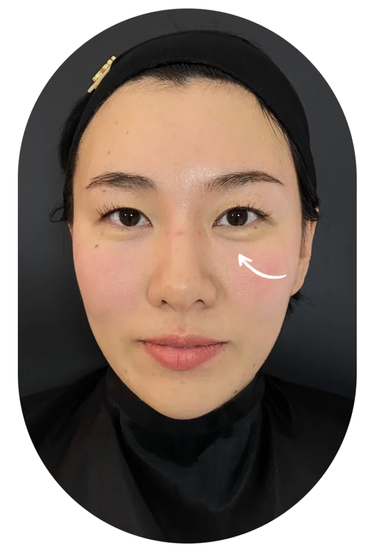 Miss Nan Under Eyes Filler Before Case 86
