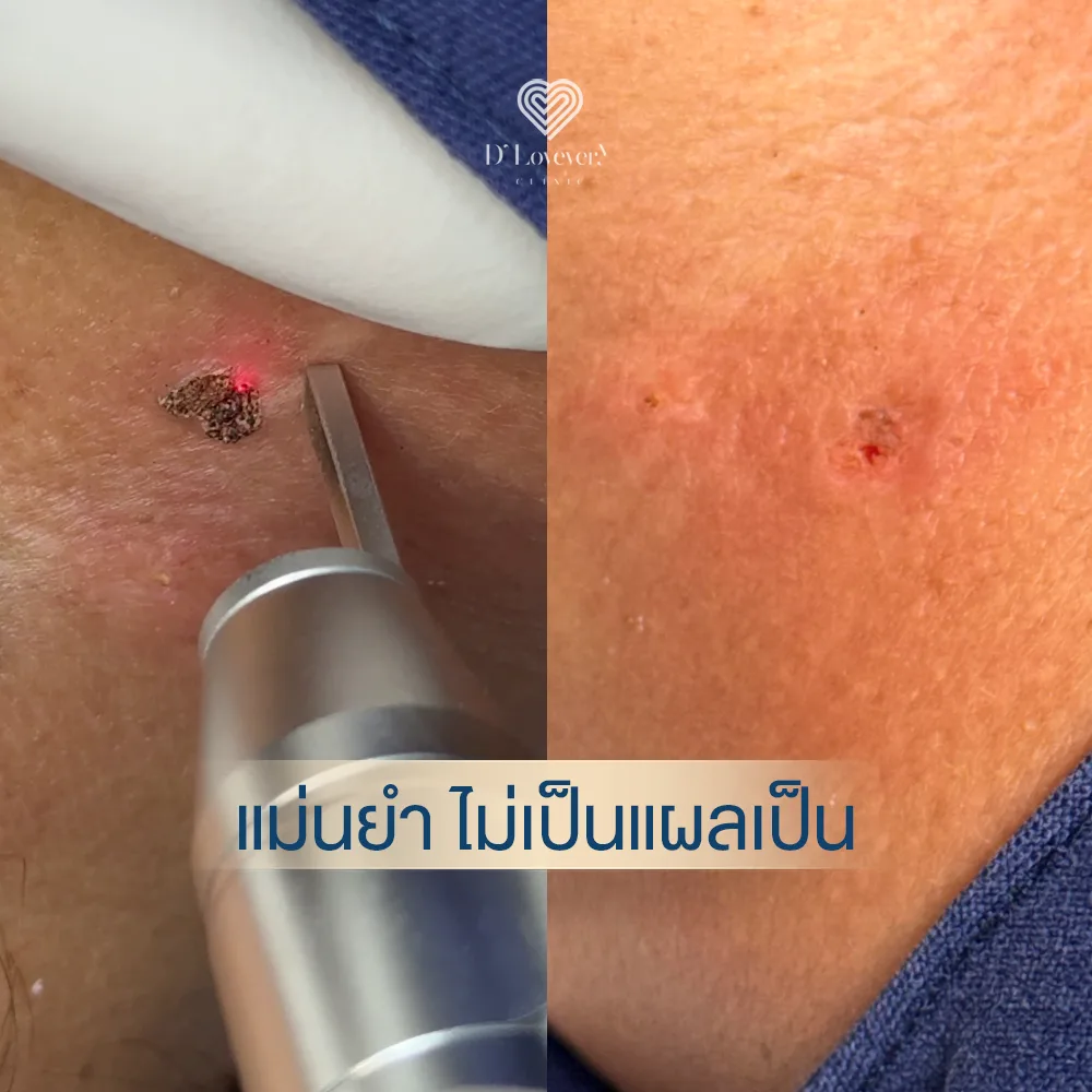 Precision mole removal before and after: crusty lesion and immediate pinpoint wound.