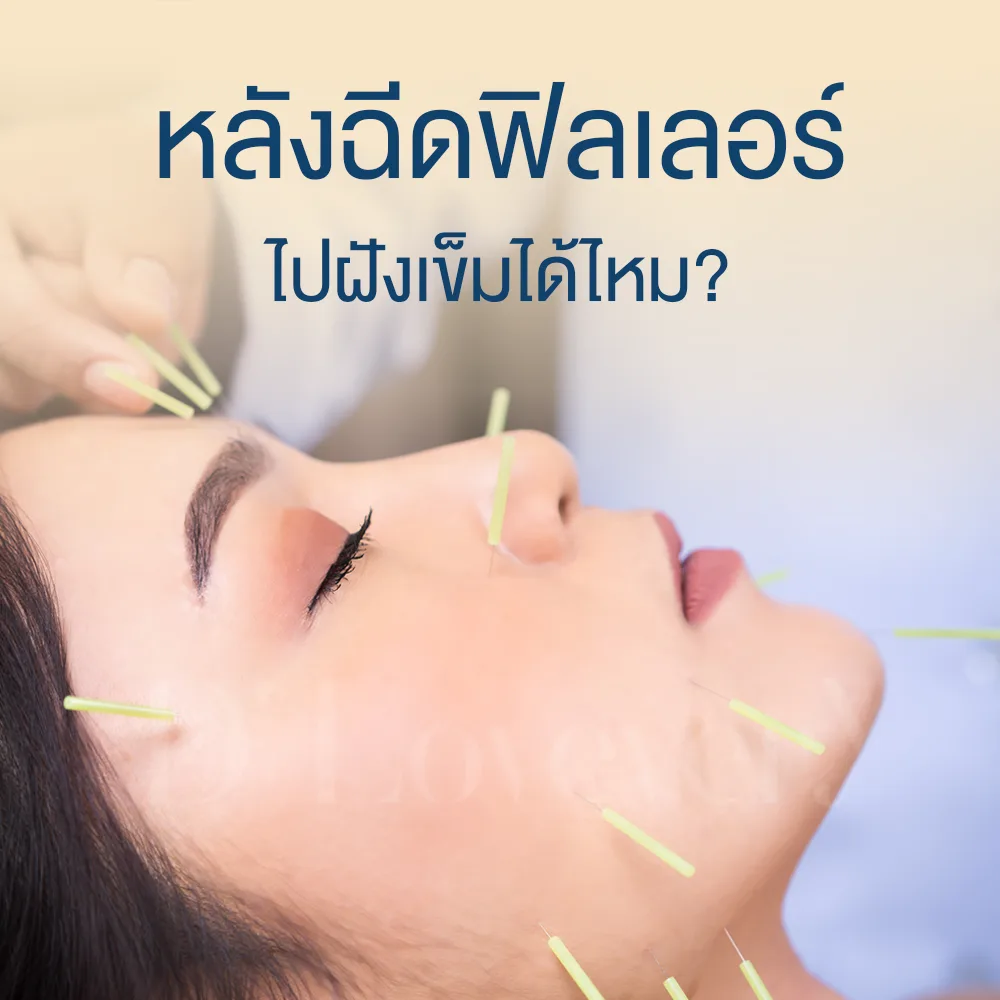 Post-filler facial acupuncture: thin needles on womans face, safety consideration