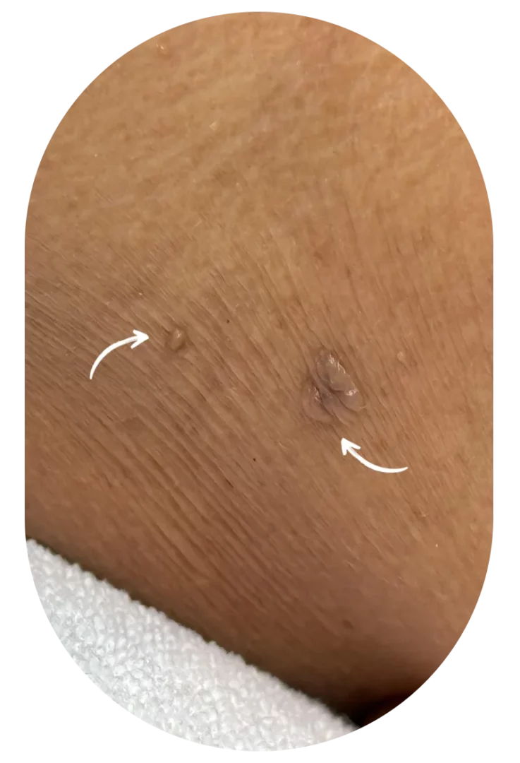 Close-up of two small neck skin tags, flesh-colored, benign, cosmetic dermatology