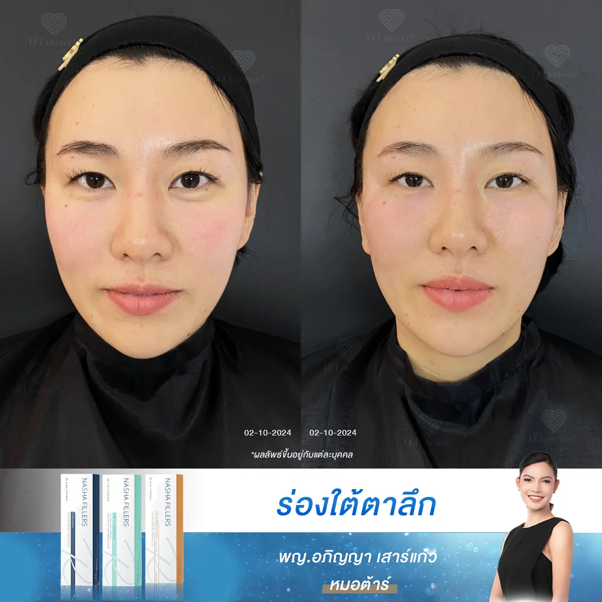 [รีวิว Under eyes Filler] อยากให้ร่องใต้ตาดูจางลงและผิวบริเวณนี้เนียนสม่ำเสมอ ฟิลเลอร์คือทางเลือกอันดับ 1