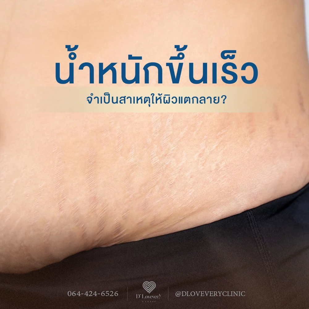 Belly stretch marks from rapid weight gain clinic ad