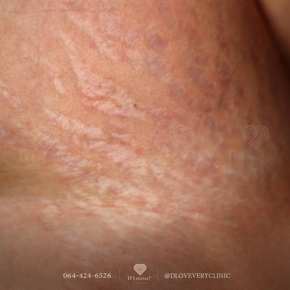 Pale linear stretch marks on peach-toned skin after rapid weight gain.