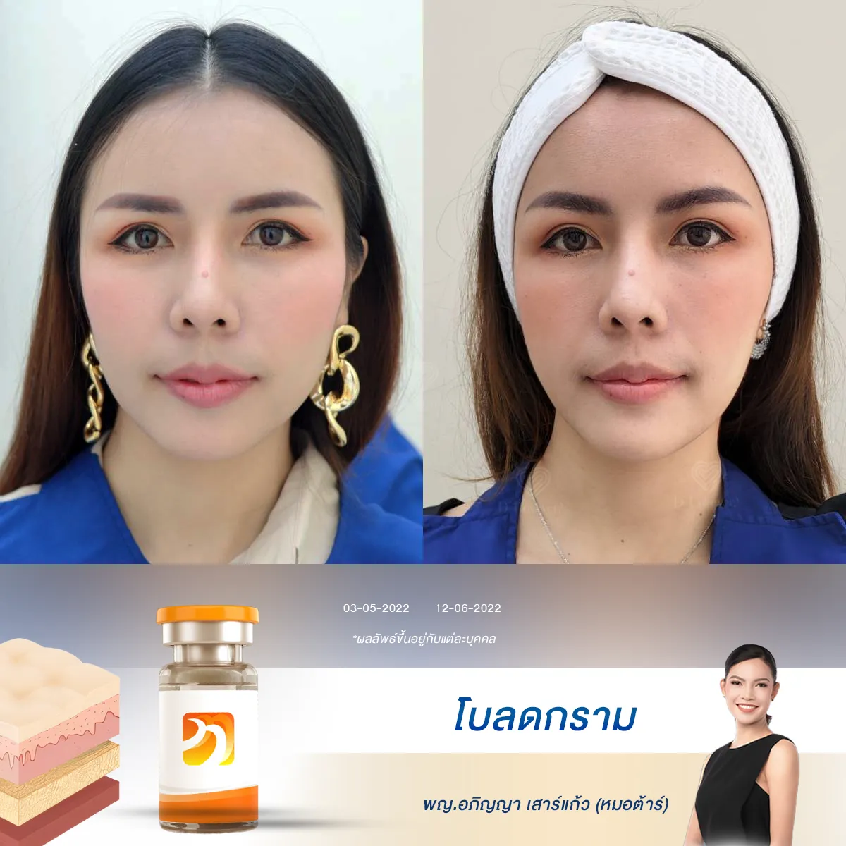 [รีวิวโบท็อกซ์] ใครบอกริ้วรอยคือเรื่องเล็ก หลัง 3 วันแรก เห็นความต่างเลย