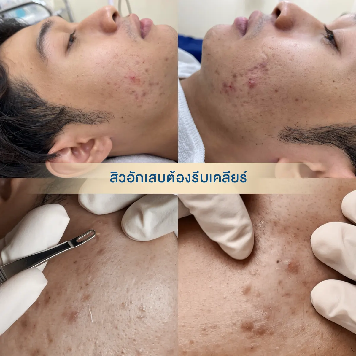 A comprehensive review: The D'Acne acne treatment program can truly transform damaged skin into radiant skin.