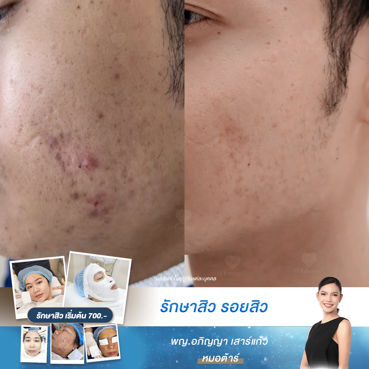 [รีวิวกำจัดสิวใน 1 เดือน] สิวอักเสบที่แก้มหรอ หมอขอเวลา 4 สัปดาห์!