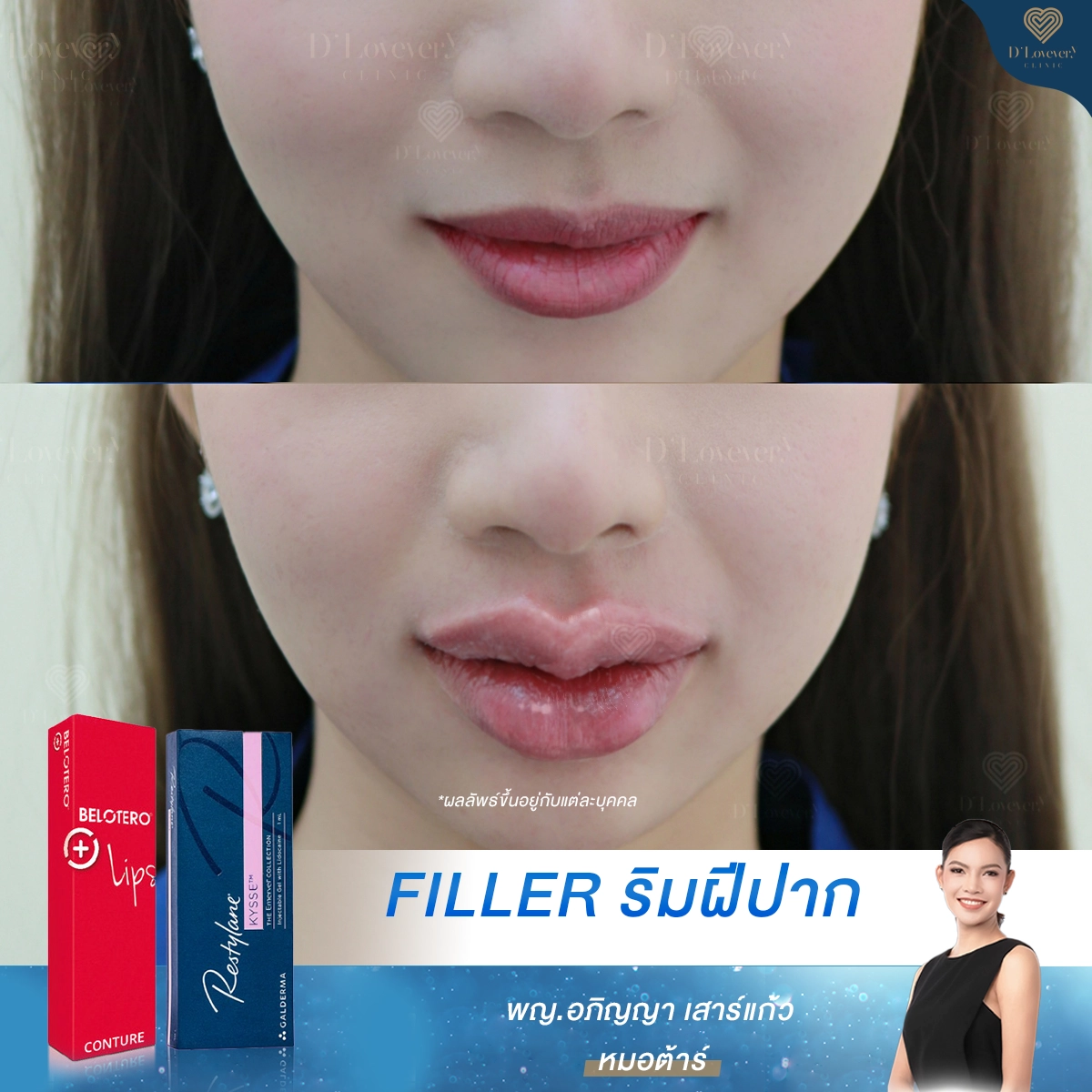 [รีวิวฉีดปาก] ย่านเลียบด่วน-รามอินทรา ฟิลเลอร์ปาก อวบอิ่ม ทรงชัด ที่ D’ Lovevery Clinic
