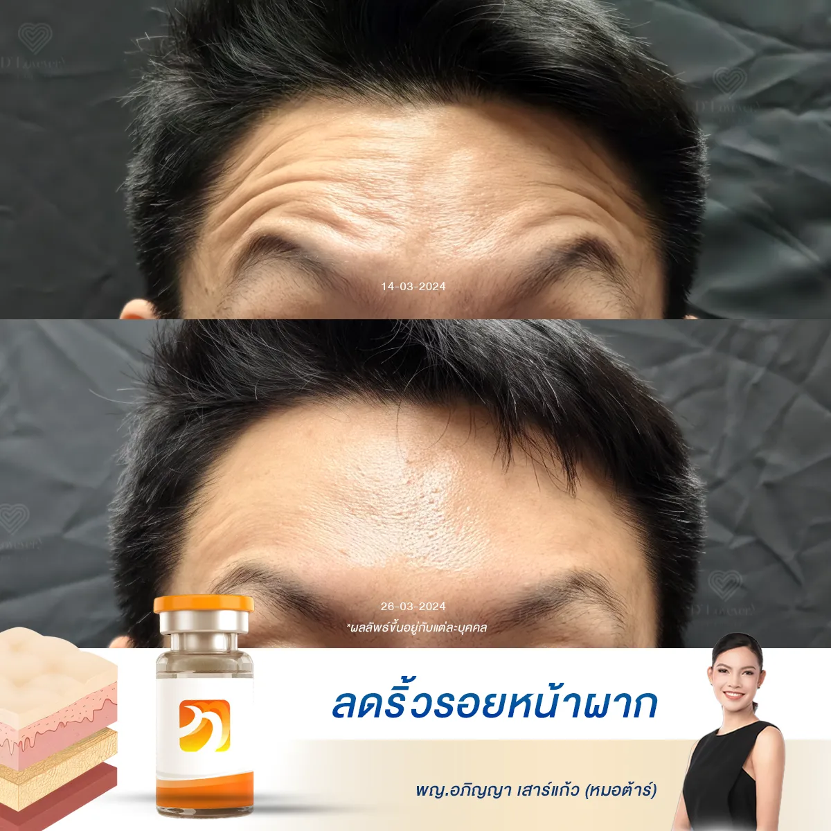 [รีวิววิธีลดริ้วรอยแห่งวัย] เผยเคล็ดลับหน้าเด็กของคุณผู้ชาย ทำงานหนักก็ยังดูสดใสได้