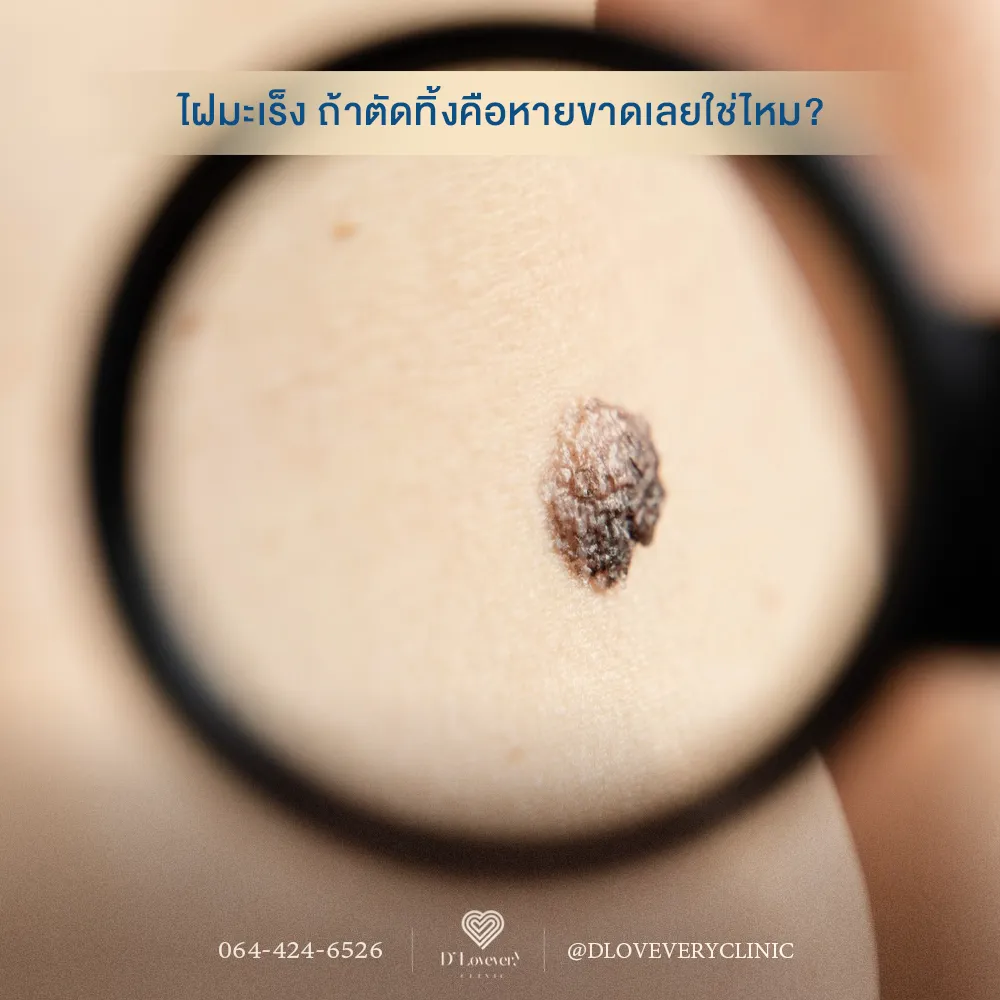 Magnified irregular dark mole—skin cancer removal question with clinic contact overlay
