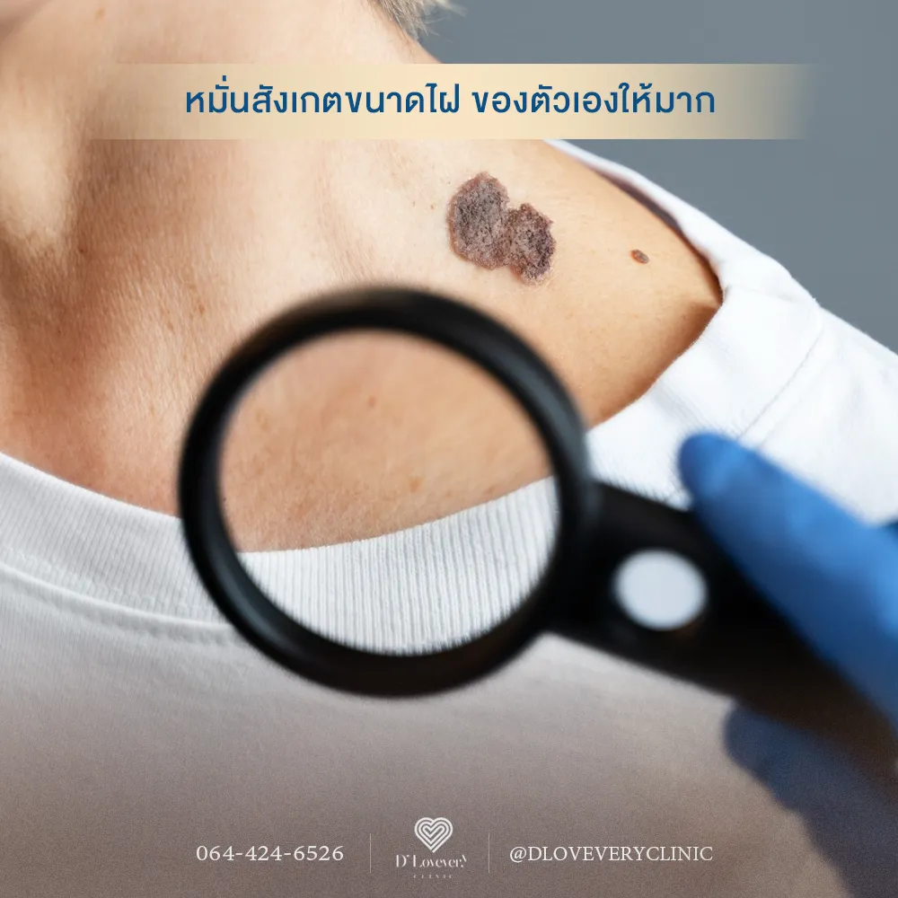 Irregular shoulder mole examined with magnifying glass for skin cancer monitoring