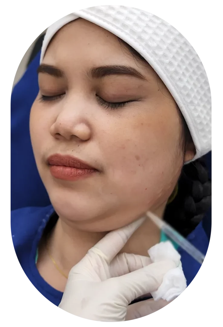 Teen Botox Vshape Case110 Before