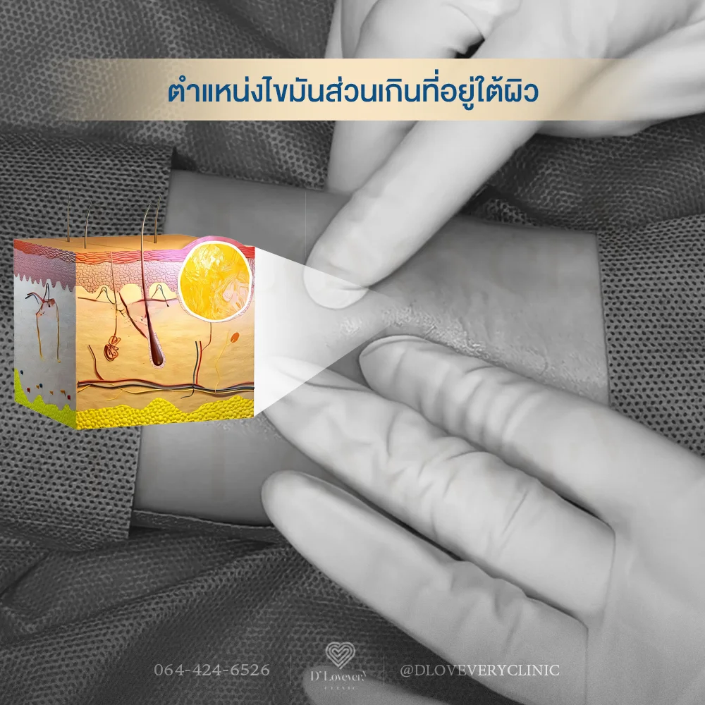 ตำแหน่งไขมันใต้ชั้นผิว ประเมินโดยแพทย์ก่อนผ่าตัด