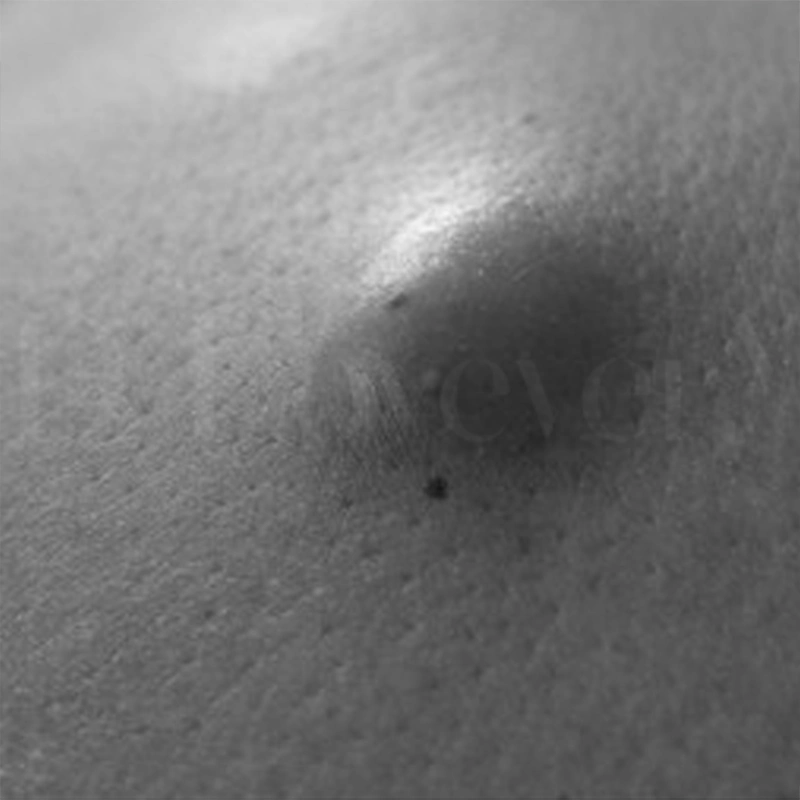 ซีสต์ไขมันใต้ผิวหนัง (Sebaceous cyst)