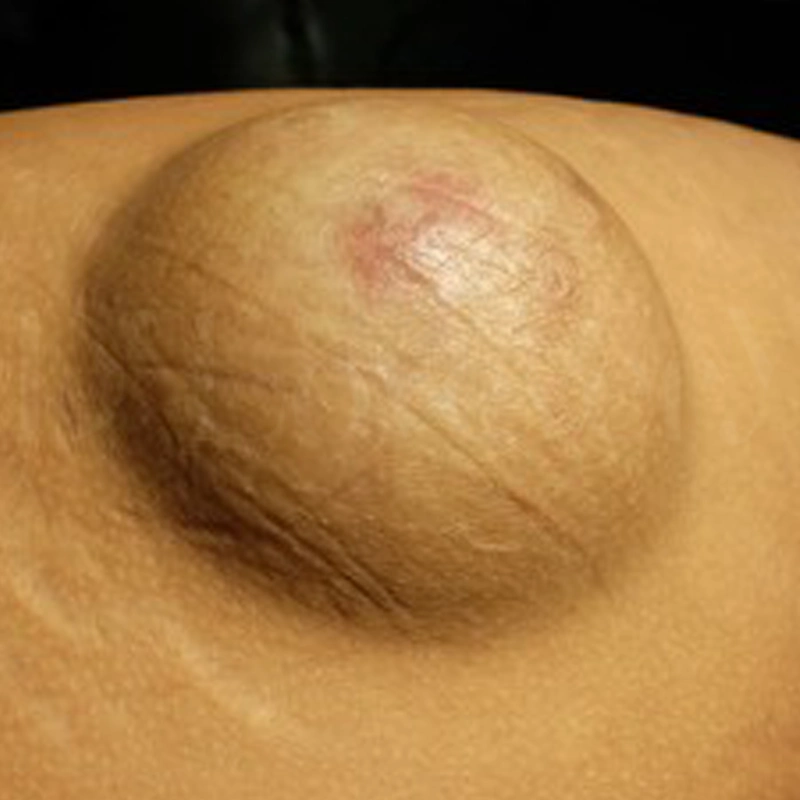 ซีสต์ไขมันใต้ผิวหนัง (Sebaceous cyst)
