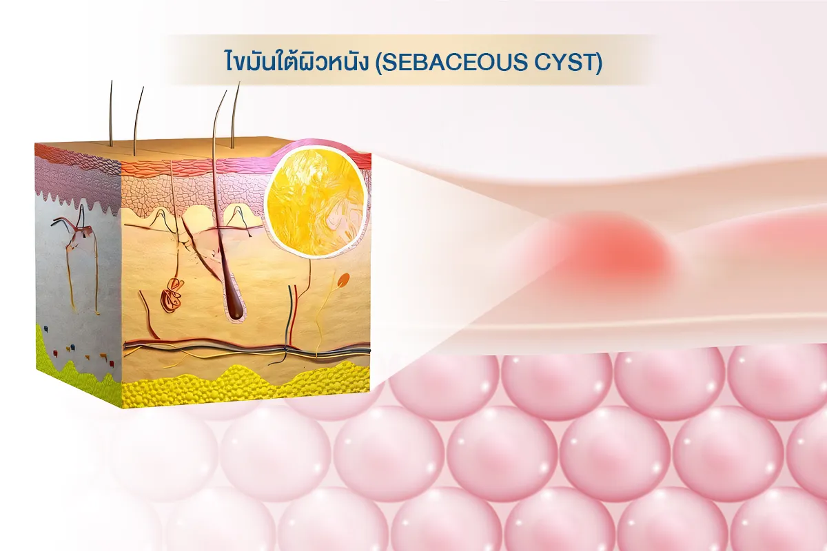 ซีสต์ไขมันใต้ผิวหนัง (Sebaceous cyst)
