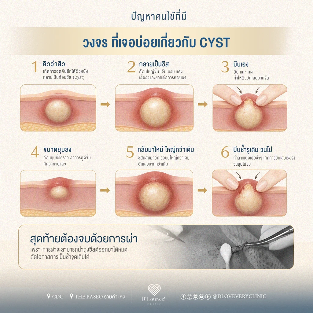 Vicious Cycle (วงจรอุบาทว์): แสดงลูปความผิดพลาดตั้งแต่ คิดว่าเป็นสิว → → บีบเอง → → ยุบชั่วคราว → → โตขึ้นใหม่ → → บีบซ้ำจนผิวช้ำดำคล้ำ ซึ่งจะวนกลับไปที่การบีบซ้ำเรื่อย ๆ ตราบใดที่ยังไม่ได้ผ่าตัดเอาถุงออก