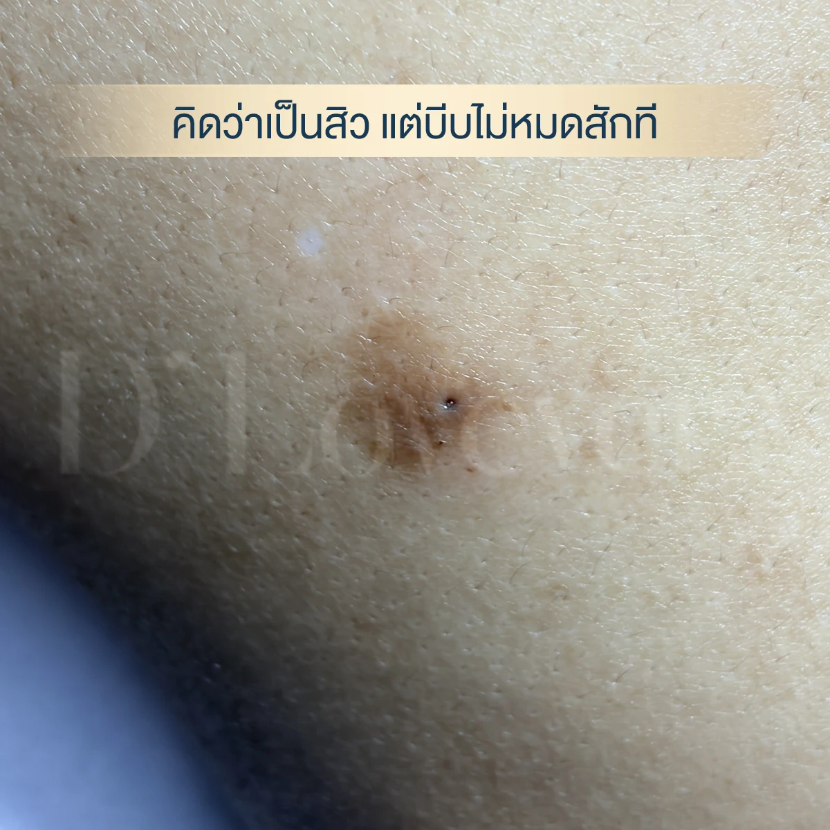 คิดว่าเป็นสิว
→
→ บีบซ้ำ
→
→ แผลช้ำ
→
→ ต้องผ่าตัด
แต่ซีสต์จะไม่หายไป จนกว่าจะผ่าถุงข้างในออก