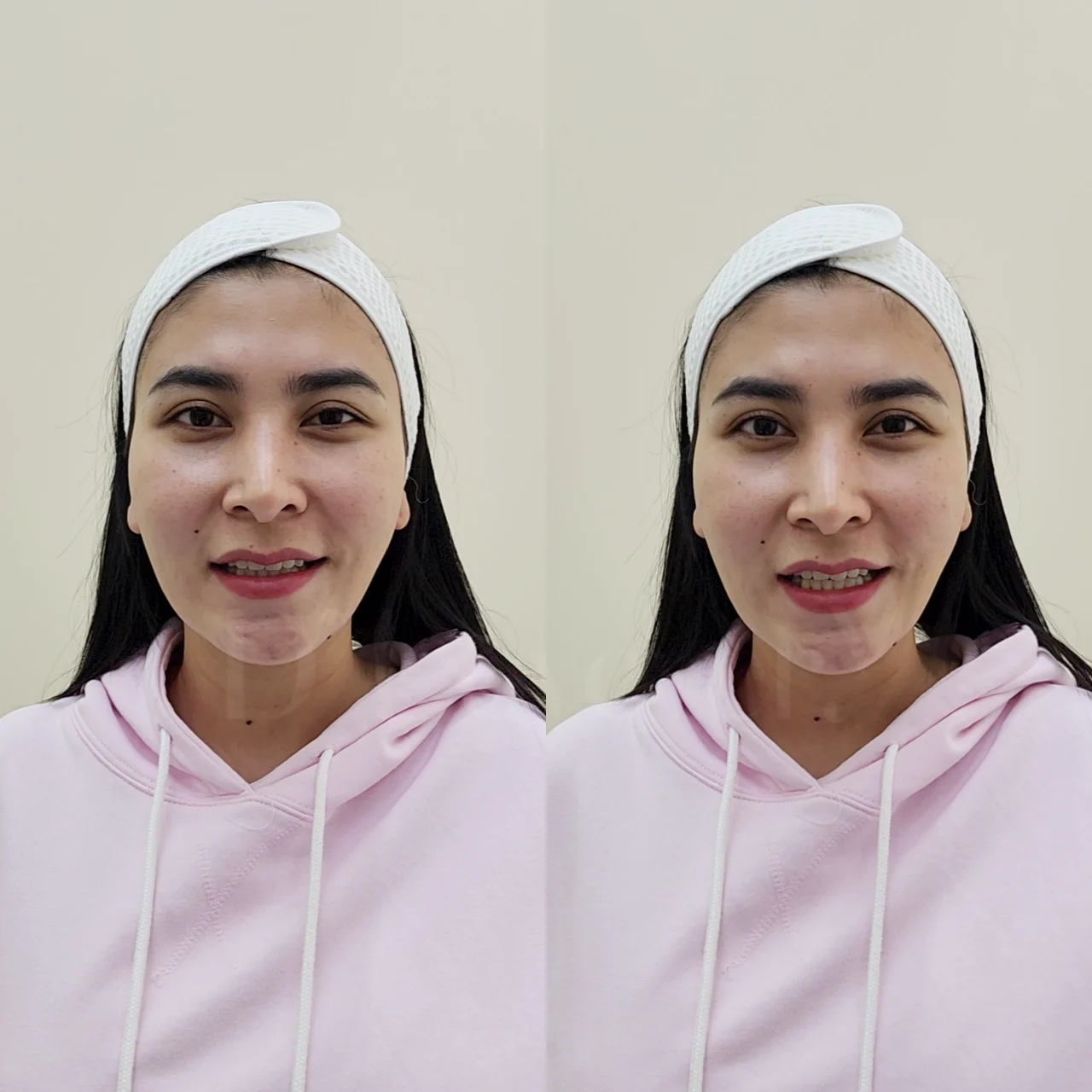 ก่อนทำฟิลเลอร์ [รีวิว] ฟิลเลอร์ใต้ตา ใกล้ CDC, รามคำแหง สวยปังจนเพื่อนทัก! ราคาเริ่มต้น 7999 บาท เห็นผลทันที