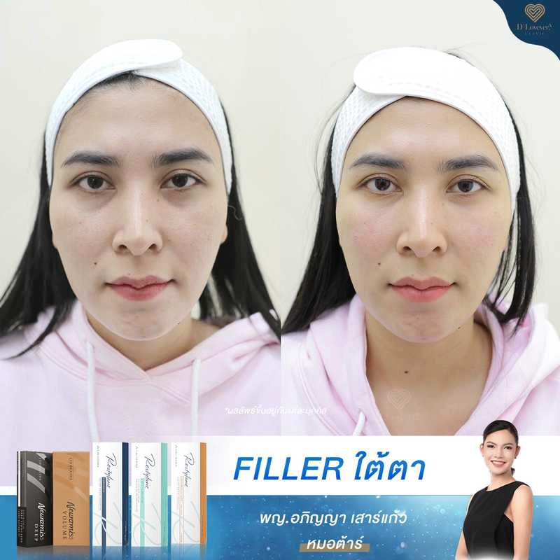 ก่อนทำ หลังทำทันที [รีวิว] ฟิลเลอร์ใต้ตา ใกล้ CDC, รามคำแหง สวยปังจนเพื่อนทัก! ราคาเริ่มต้น 7999 บาท เห็นผลทันที