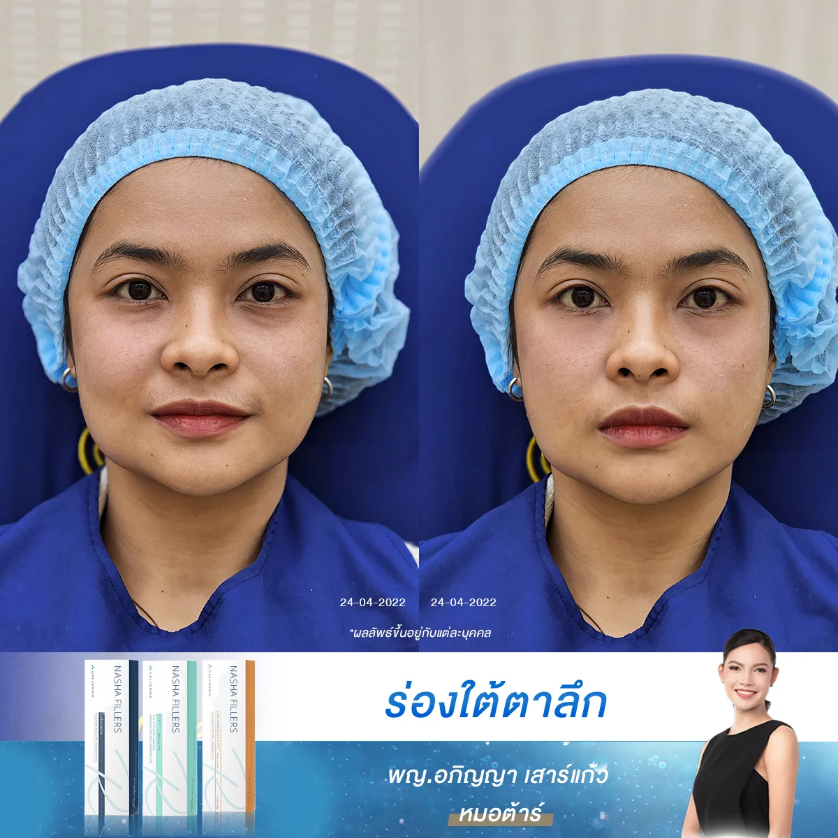 [รีวิว] กู้ใต้ตาคล้ำให้สดใส! หน้าไม่เหนื่อย ฟิลเลอร์ใต้ตาที่ D’ Lovevery Clinic