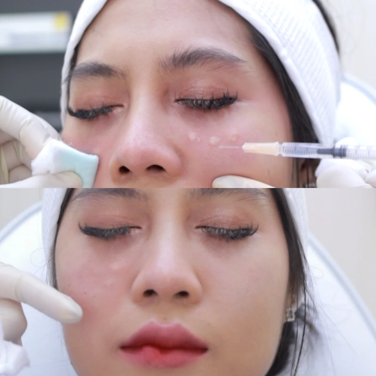 Under-eye Rejuran injection before-and-after, syringe and treated cheek