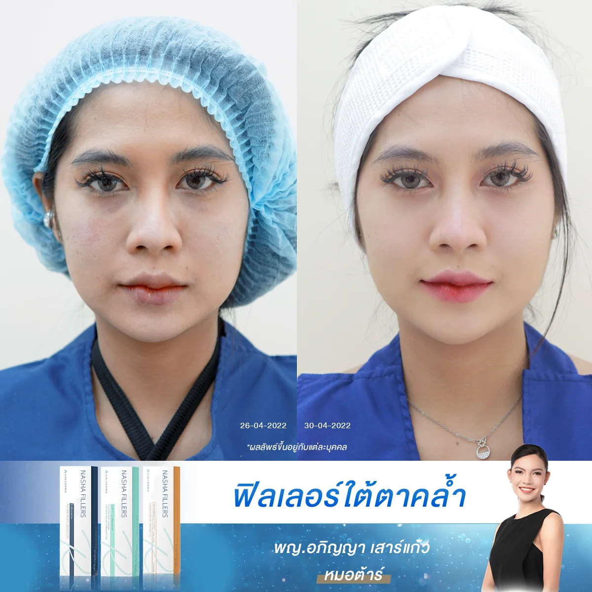[รีวิวฉีดใต้ตา] ใครเป็นแบบเคสนี้บ้าง ใต้ตาคล้ำพาให้แต่งหน้าไม่รอด โปรแกรมฟิลเลอร์เปลี่ยนทุกอย่างไปเลย
