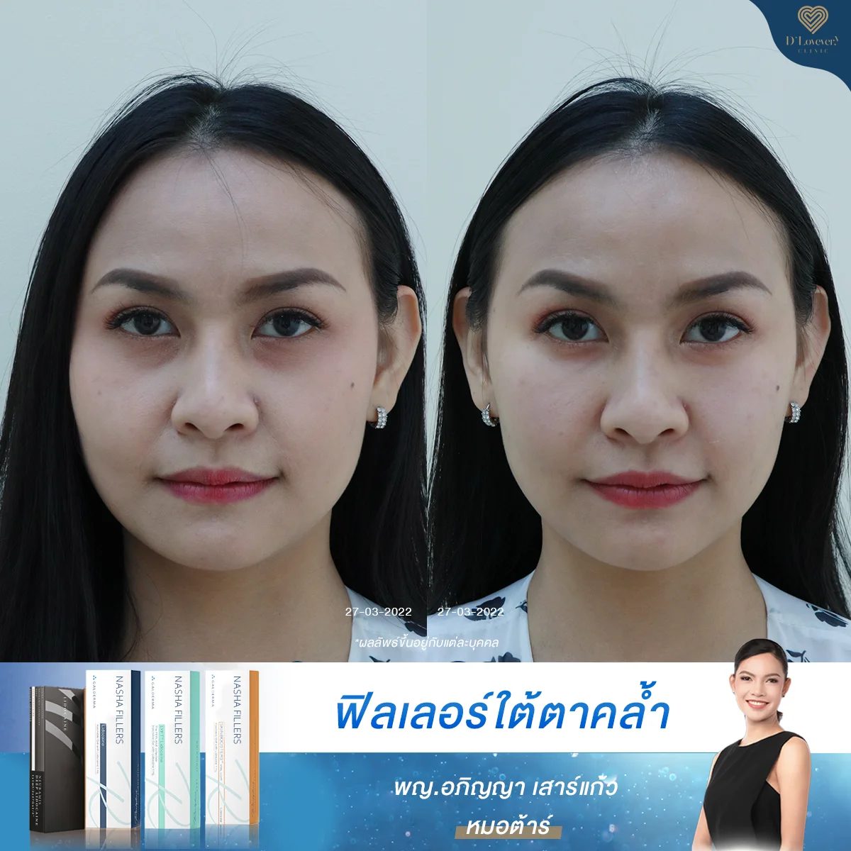 [รีวิวใต้ตาคล้ำ] โดนทักว่าใต้ตาหมองจนท้อ จบที่ฟิลเลอร์ใต้ตา เห็นผลทันที