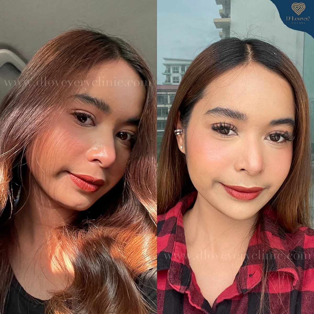 [รีวิวฟิลเลอร์คาง] คางบุ๋มหรอ เรื่องเล็ก! ฟิลเลอร์รับจบ เติมคางครั้งเดียวสวย มั่นใจขึ้น 100%