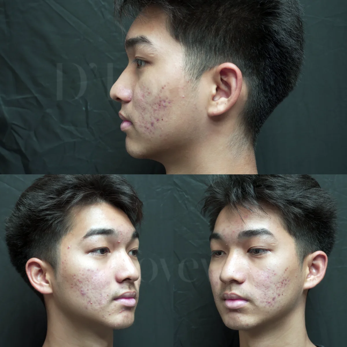 รีวิวพลีชีพน้องผู้ชาย สิวเห่อหนักมาก จนเกือบถอดใจ รักษายังไงให้ผิวกลับมาใสอีกครั้ง