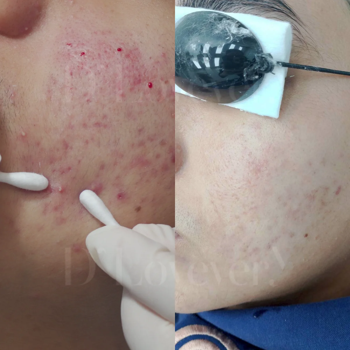 [รีวิวโปรแกรมรักษาสิว] เจาะลึกโปรแกรม D’ Acne Size L ทางออกของคนเป็นสิวเรื้อรัง กดสิว ฉายแสง จบในที่เดียว