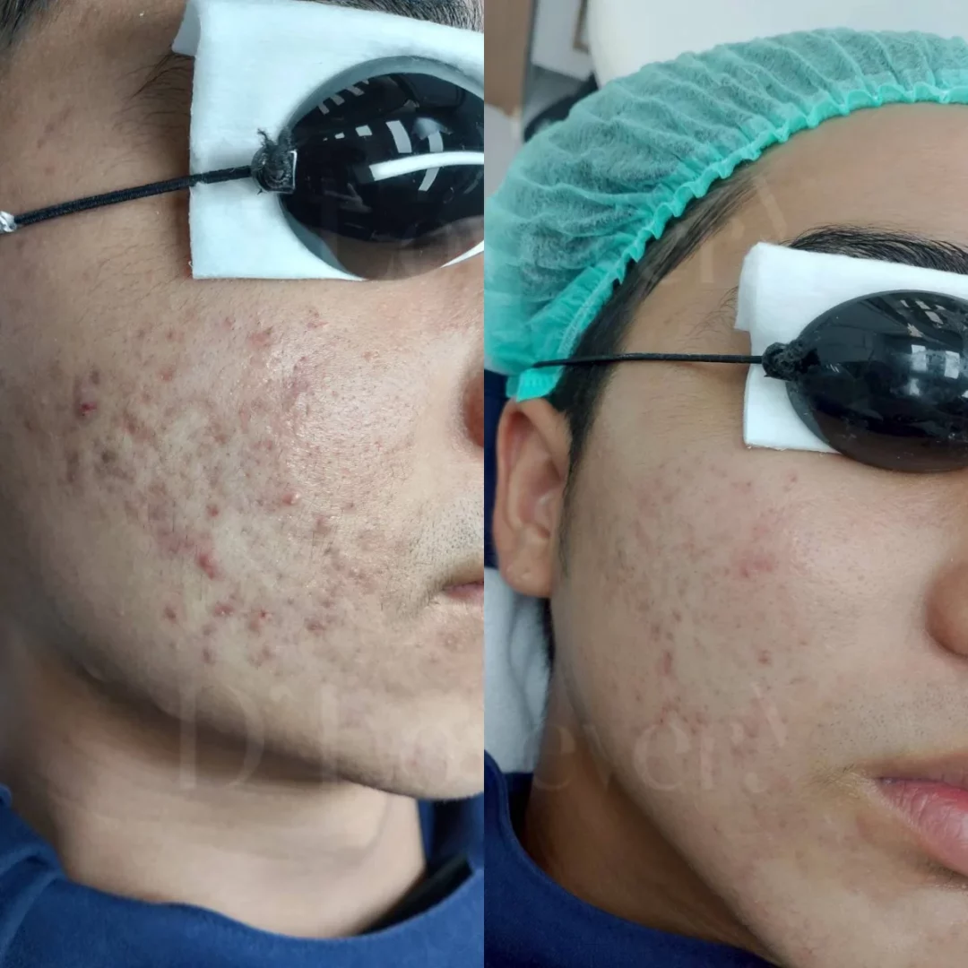 ตามหาคลินิกรักษาสิว แถวเซ็นทรัลอีสต์วิลล์ แนะนำโปร D' Acne L คุ้มสุดในย่านนี้