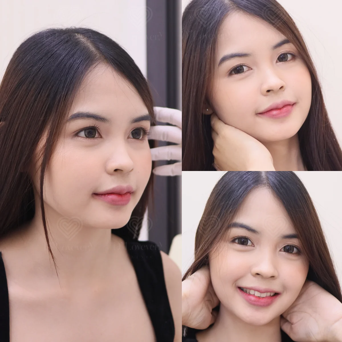 [รีวิวกำจัดสิว] สิวผด บุก เคลียร์จบครบสูตร D Facial ทรีทเมนท์สูตรเฉพาะ ใครผิวแพ้ง่ายต้องลอง