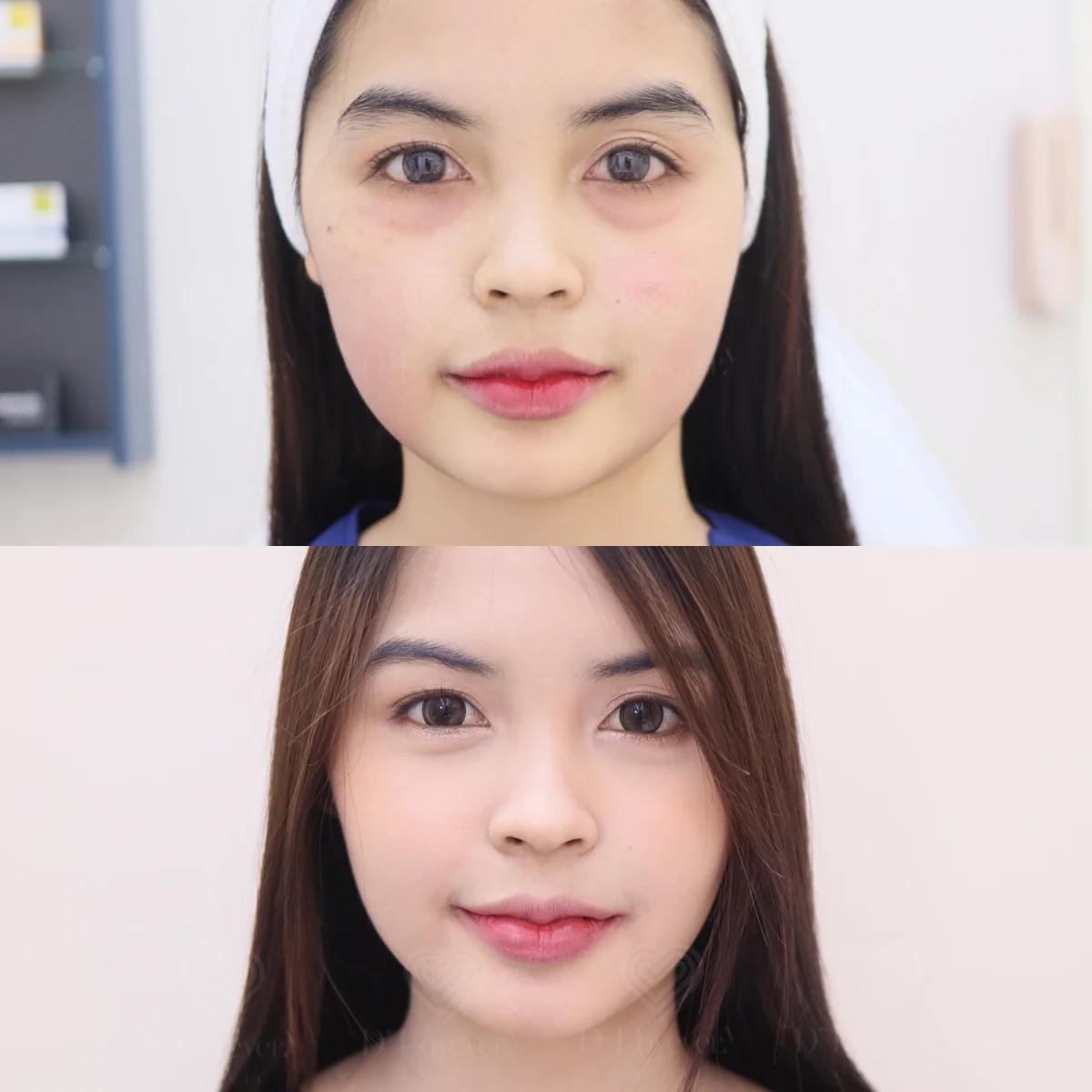 D' HYA ใต้ตาหมองคล้ำ ฉีดอะไรให้สดใสสดชื่น เหมือนคนพักผ่อนเพียงพอ