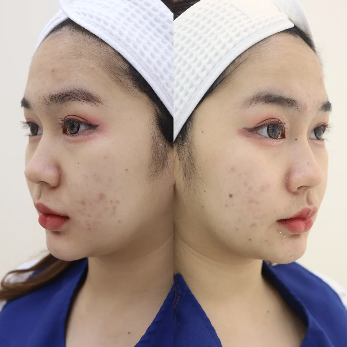 จัดโปรฯ สู้สิว! ดีเลิฟเวอรี่ คลินิก สาขาพาซิโอ รามคำแหง ราคาดีจนต้องบอกต่อ
