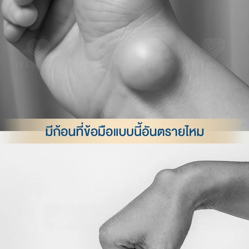 มีก้อนที่ข้อมือ? อย่าเพิ่งกดหรือเจาะเอง! คุณหมอความงามเผยสาเหตุ วิธีวินิจฉัย & รักษาอย่างปลอดภัย เพื่อสุขภาพข้อมือที่ดีของคุณ ผ่าตัดออก เริ่มต้น 7500 บาท